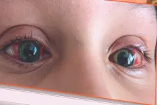 Covid může u dětí výjimečně vyvolat zánětlivé onemocnění, projevuje se třeba zarudlýma očima