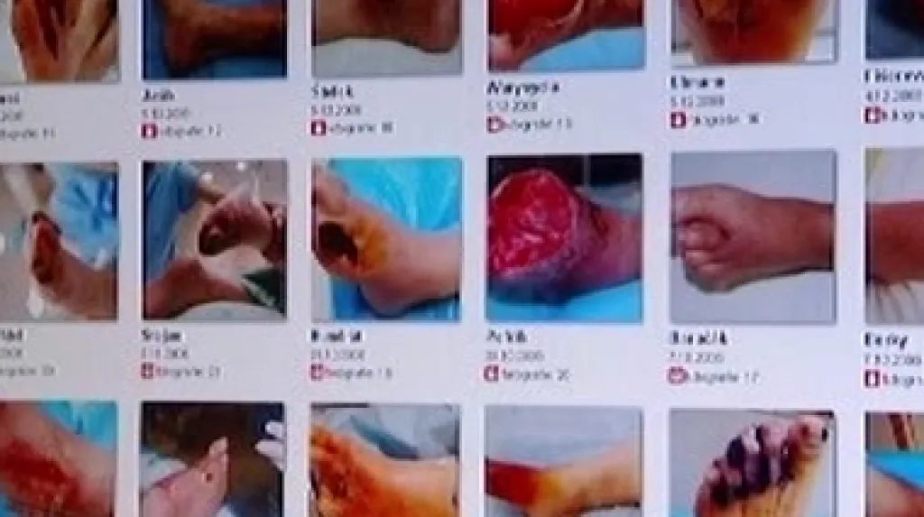 Onemocnění dolních končetin