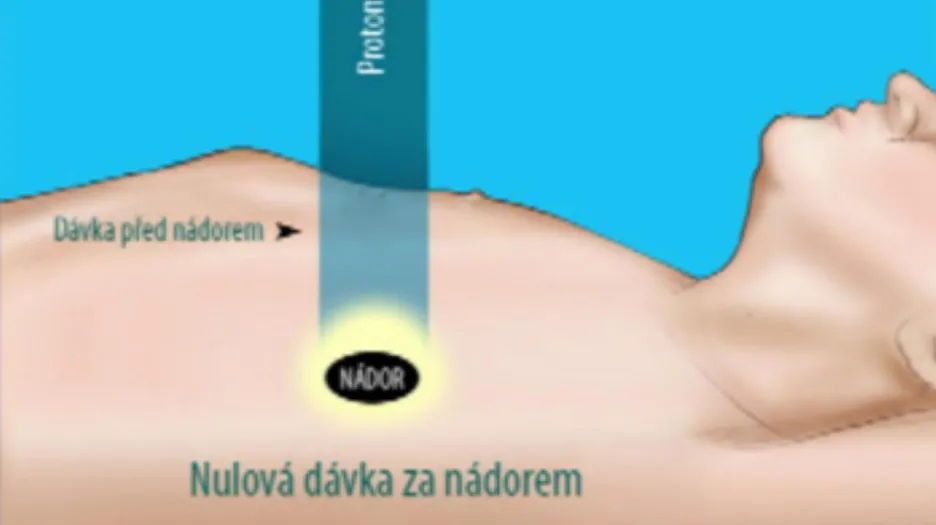Protonový paprsek pronikne pouze k nádoru