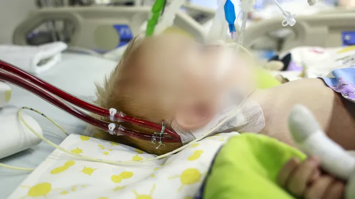 Napojení kanyl mimotělní pumpy do cévního systému dětského pacienta