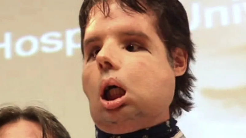 Španěl Óscar, který jako první podstoupil transplantaci celého obličeje, se poprvé ukázal na veřejnosti