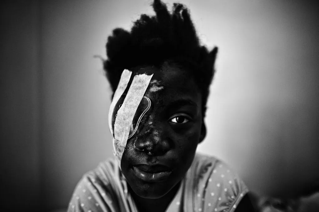 Fotografie roku 2010.Dívka hospitalizovaná v nemocnici se zraněným okem a tváří při zemětřesení.