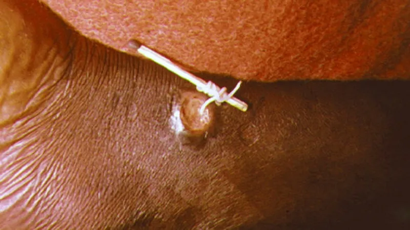 Vlasovec se dá vytahovat pomocí zápalek