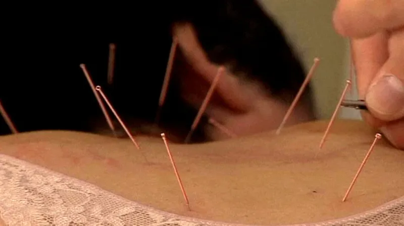 Akupunktura