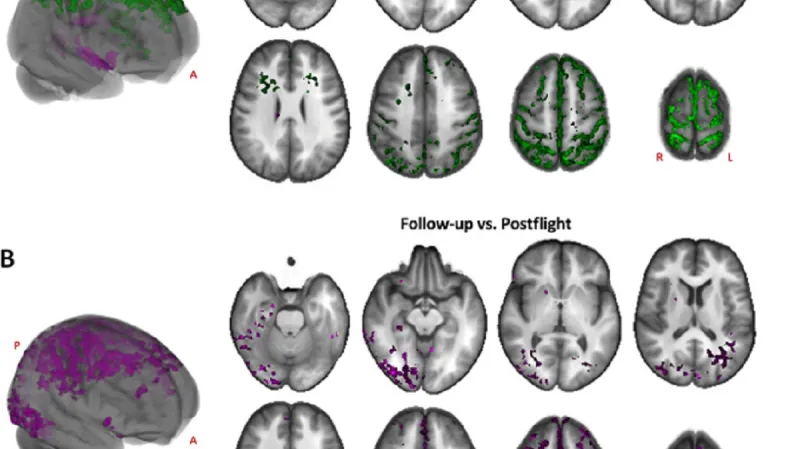 Změny mozku před pobytem v kosmu a po něm